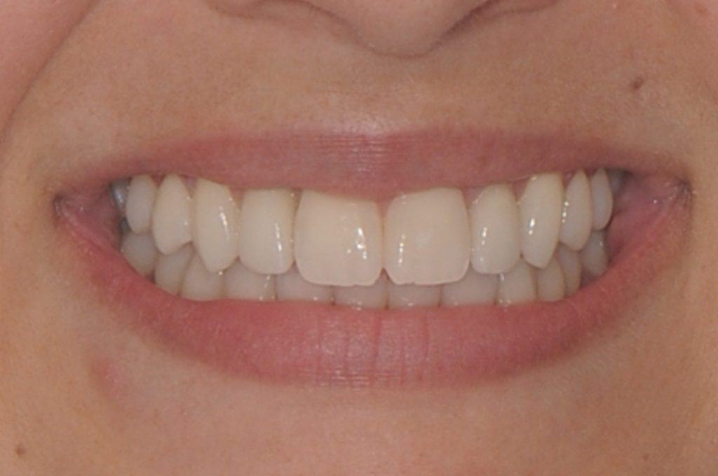 After undefined - Wisdom Tooth Extraction