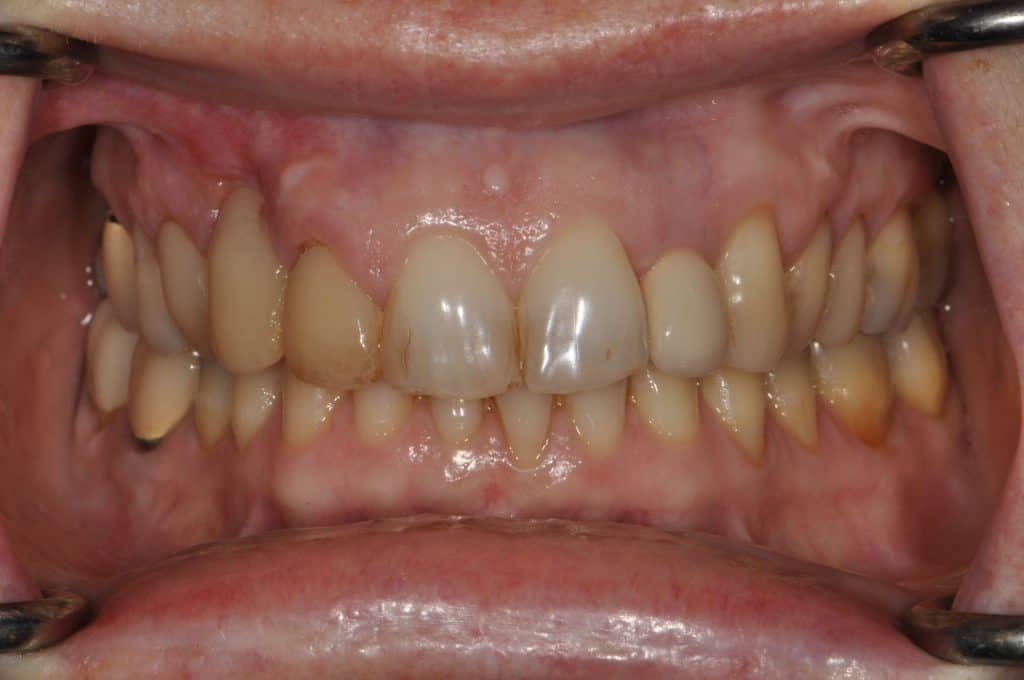 Before undefined - Wisdom Tooth Extraction