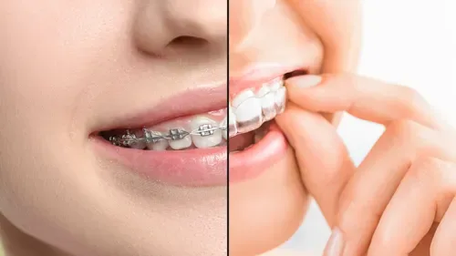Clear aligners and traditional metal braces side-by-side comparison for teeth straightening — Dr. Sri Sushma Dental Clinic Anandbagh Hyderabad