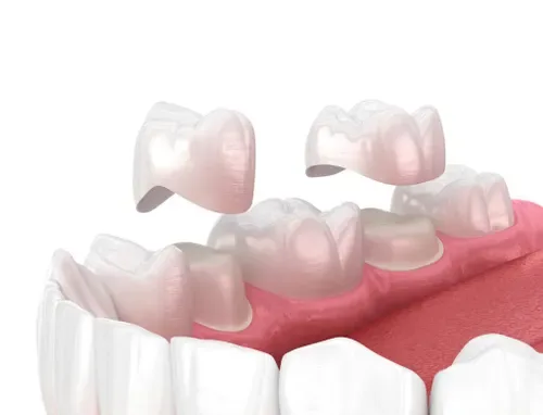Dental crowns and bridges restorations guide — Dr. Sri Sushma Dental Clinic Anandbagh Hyderabad
