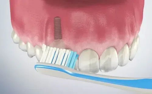 Patient brushing and maintaining dental implants for long-term oral health — Dr. Sri Sushma Dental Clinic Anandbagh Hyderabad