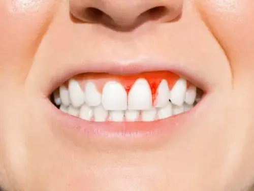 Gum Disease in Hyderabad: Signs, Stages, and When to Treat It