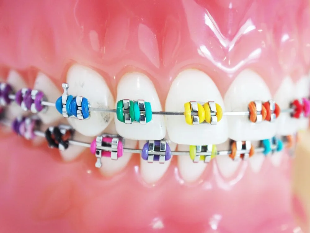 Dental Braces at Dr. Sri Sushma Multispeciality Dental Clinic, Anandbagh Hyderabad