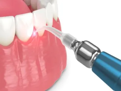 Laser Treatment - Dr. Sushma Dental Clinic