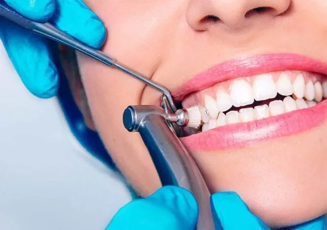 Teeth Cleaning & Polishing - Dr. Sushma Dental Clinic Hyderabad