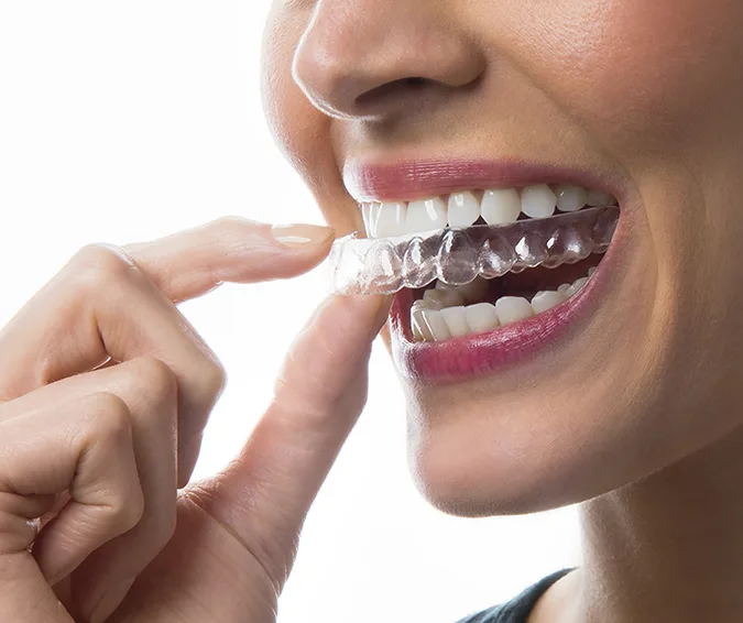 Clear Aligners at Dr. Sri Sushma Multispeciality Dental Clinic, Anandbagh Hyderabad