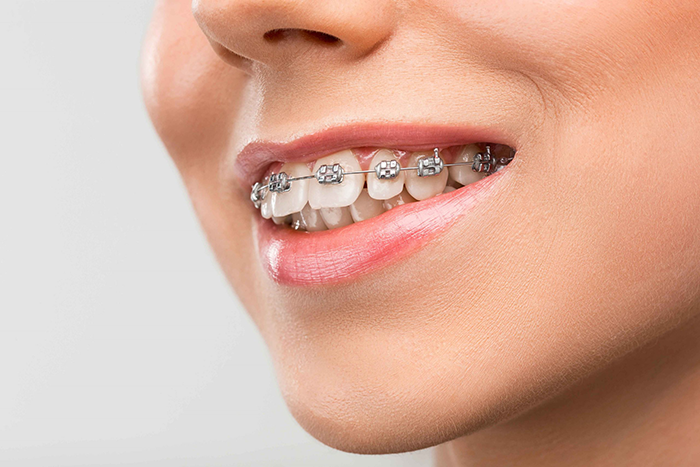 Dental Braces - Dr. Sushma Dental Clinic
