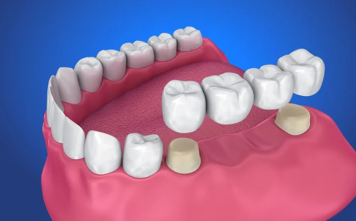 Dental Crowns & Bridges at Dr. Sri Sushma Multispeciality Dental Clinic, Anandbagh Hyderabad