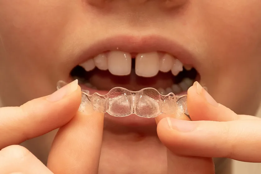 Teeth Gap Treatment at Dr. Sri Sushma Multispeciality Dental Clinic, Anandbagh Hyderabad
