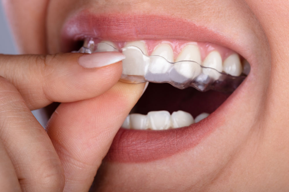 Clear Aligners Treatment Hyderabad