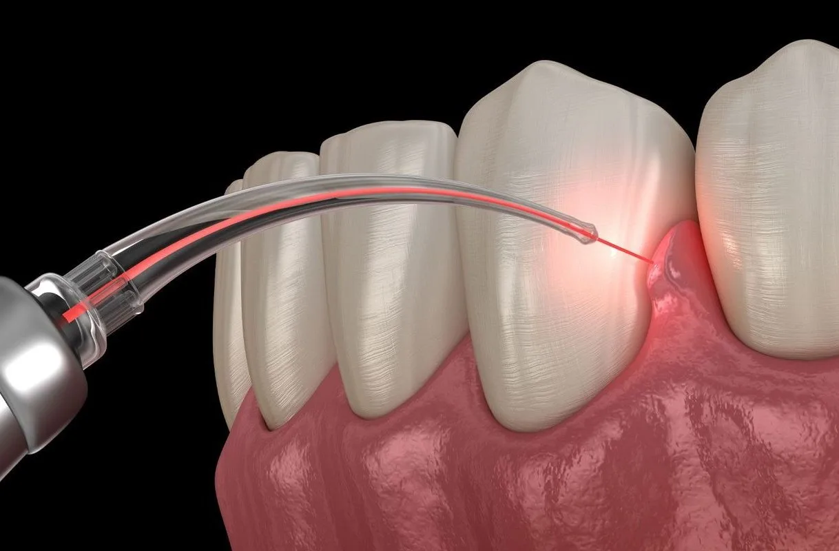 Gum Disease Treatment in Hyderabad at Dr. Sri Sushma Multispeciality Dental Clinic, Anandbagh Hyderabad