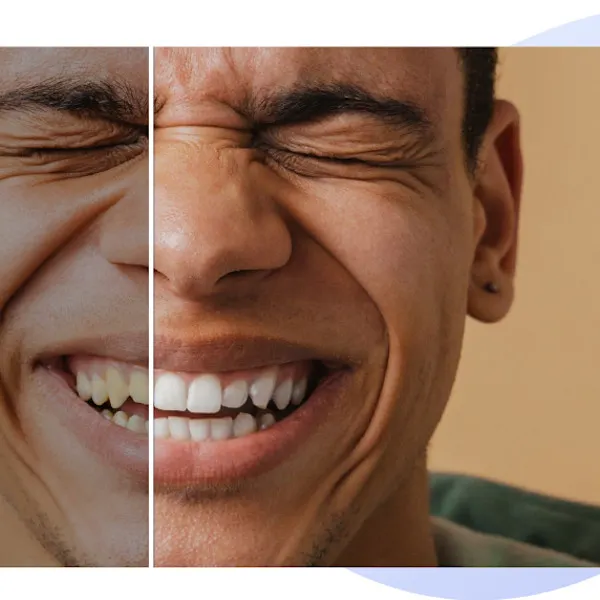 Smile Makeover at Dr.Sri Sushma Multispeciality Dental Clinic, Anandbagh Hyderabad